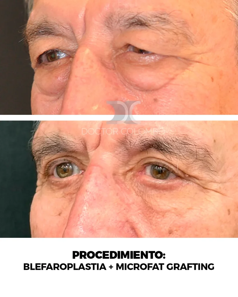 BLEFAROPLASTIA COMPLETA + MICROFAT GRAFTING — 2255 — Perfil izquierdo