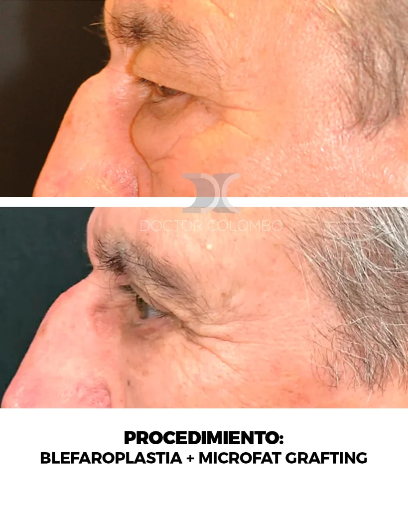 BLEFAROPLASTIA COMPLETA + MICROFAT GRAFTING — 2255 — Frontal