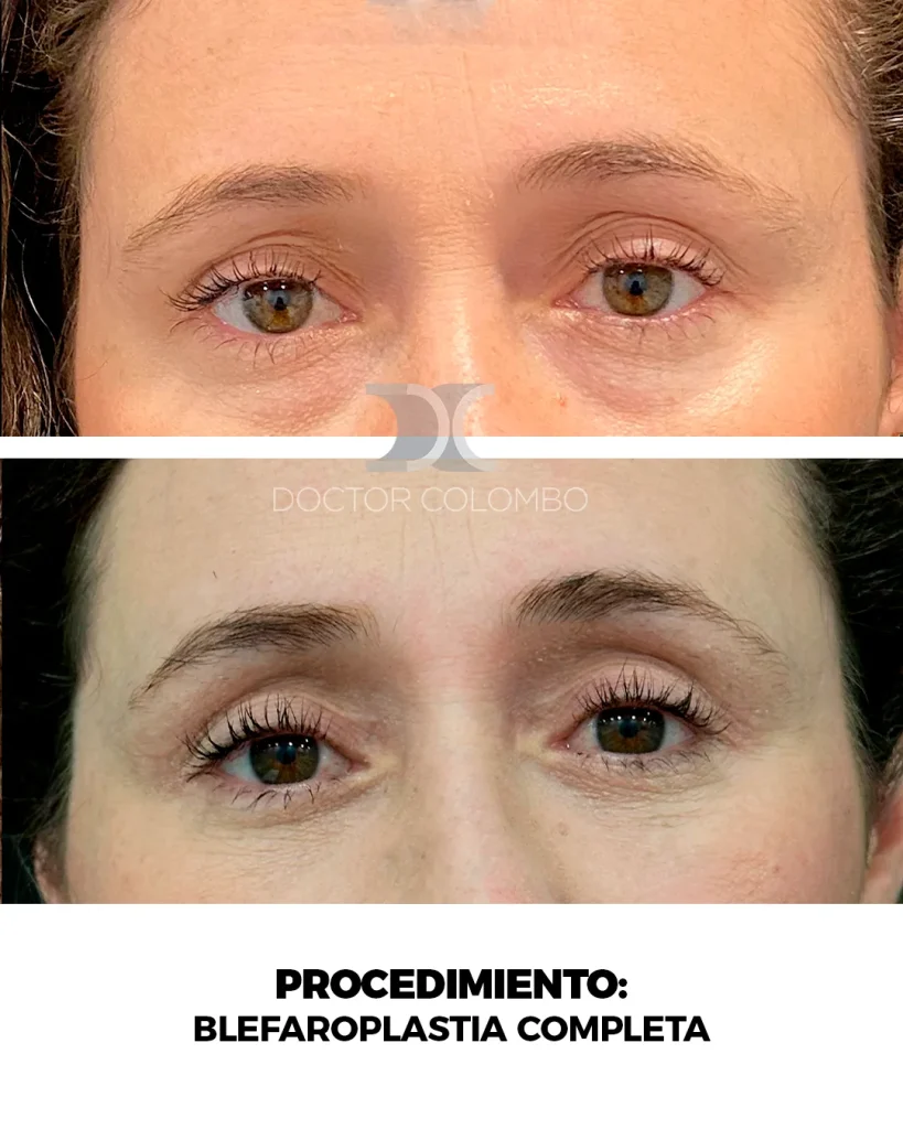 BLEFAROPLASTIA COMPLETA TRANSCONJUNTIVAL + RESECCIÓN DE BOLSAS. MICROFAT GRAFTING EN OJERAS Y NANOFAT EN PIEL. — 2943-1 — Frontal
