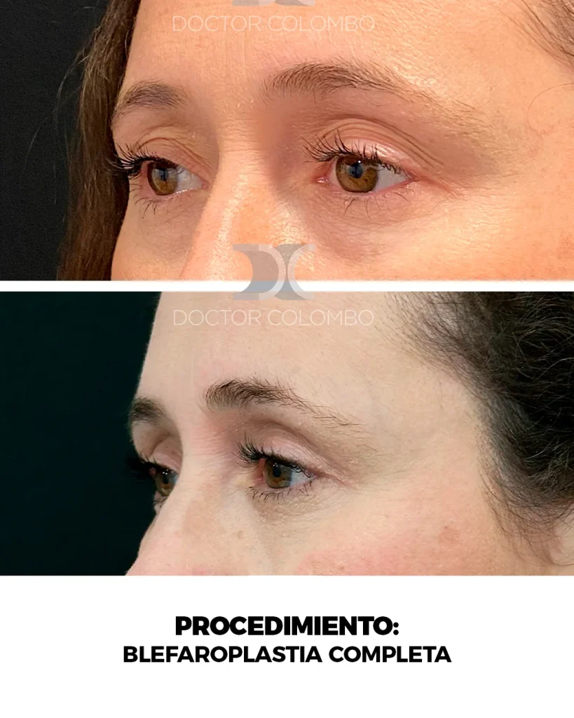 LIPOSUCCIÓN VASER® DE ABDOMEN, FLANCOS, ESPALDA Y PUBIS + MARCACION ABDOMINAL — 2943 — Perfil izquierdo