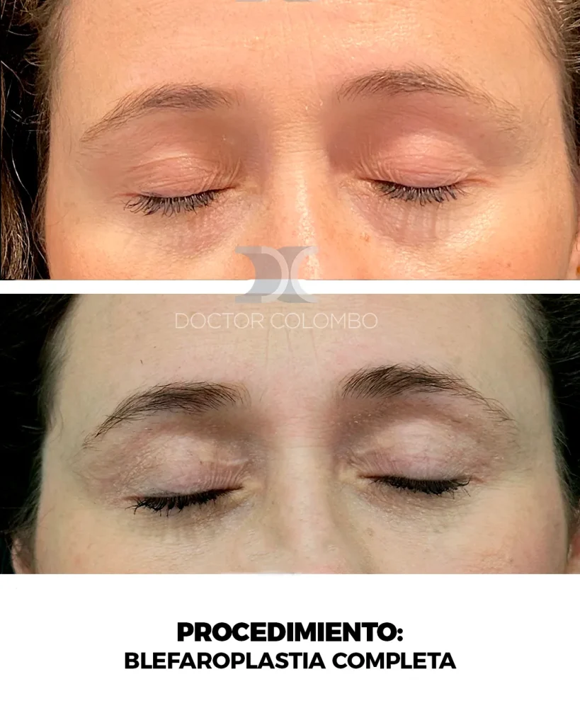 LIPOSUCCIÓN VASER® DE ABDOMEN, FLANCOS, ESPALDA Y PUBIS + MARCACION ABDOMINAL — 2943 — Frontal