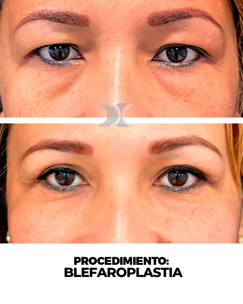 BLEFAROPLASTIA EN PARPADO SUPERIOR – BAJO ANESTESIA LOCAL — 3059 — Perfil derecho