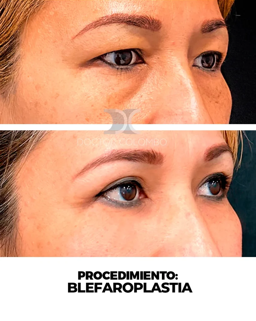 BLEFAROPLASTIA EN PARPADO SUPERIOR – BAJO ANESTESIA LOCAL — 3059 — Perfil izquierdo