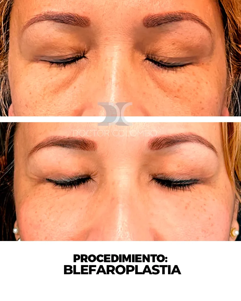 BLEFAROPLASTIA EN PARPADO SUPERIOR – BAJO ANESTESIA LOCAL — 3059 — Frontal