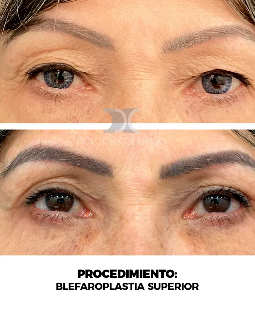 BLEFAROPLASTIA SUPERIOR E INFERIOR TRANSCONJUNTIVAL + MICROFAT GRAFTING EN PARPADO INFERIOR — 3167 — Perfil derecho