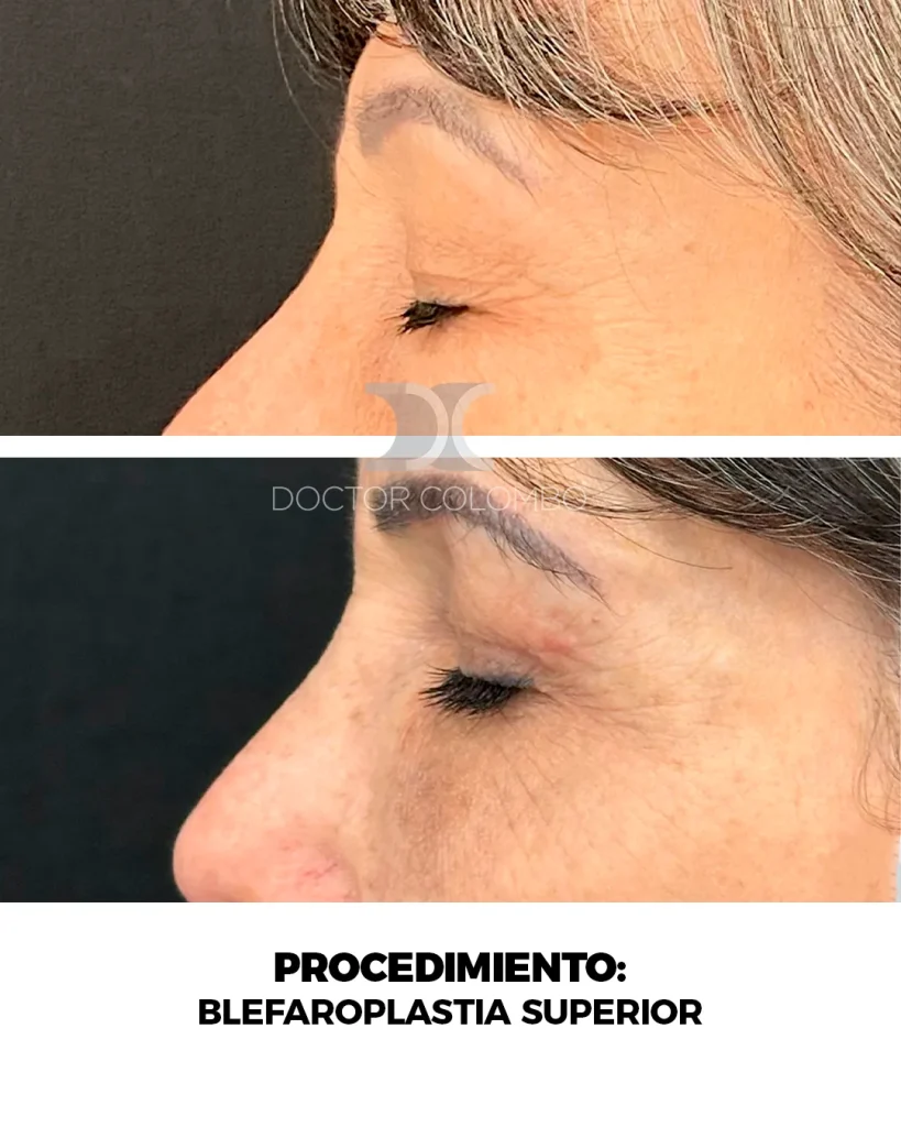 BLEFAROPLASTIA SUPERIOR E INFERIOR TRANSCONJUNTIVAL + MICROFAT GRAFTING EN PARPADO INFERIOR — 3167 — Perfil izquierdo