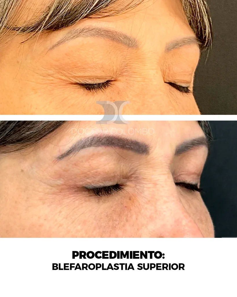 BLEFAROPLASTIA SUPERIOR E INFERIOR TRANSCONJUNTIVAL + MICROFAT GRAFTING EN PARPADO INFERIOR — 3167 — Frontal