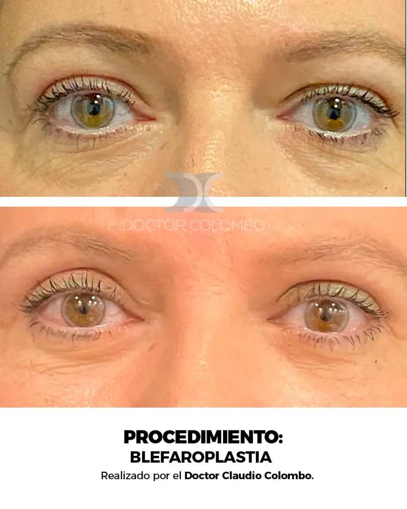 BLEFAROPLASTIA EN PARPADO SUPERIOR E INFERIOR + NANOFAT PERIORBITARIO – CON ANESTESIA LOCAL – AMBULATORIO — 5006 — Frontal