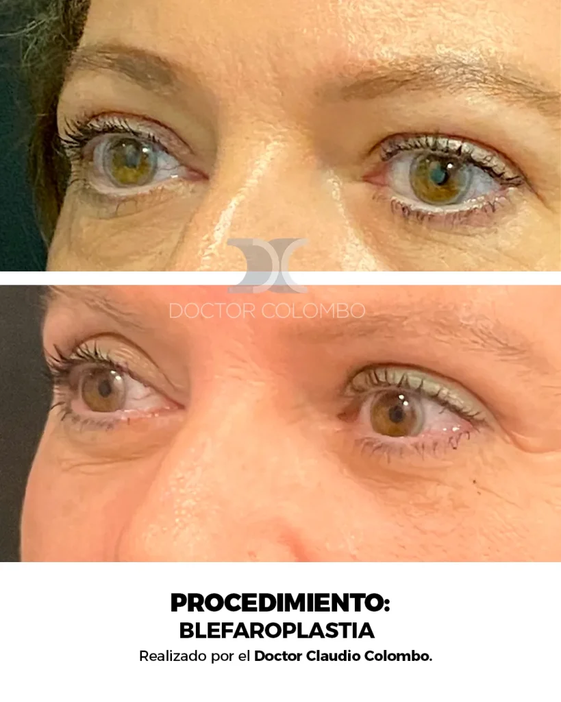 BLEFAROPLASTIA EN PARPADO SUPERIOR E INFERIOR + NANOFAT PERIORBITARIO – CON ANESTESIA LOCAL – AMBULATORIO — 5006 — Perfil izquierdo