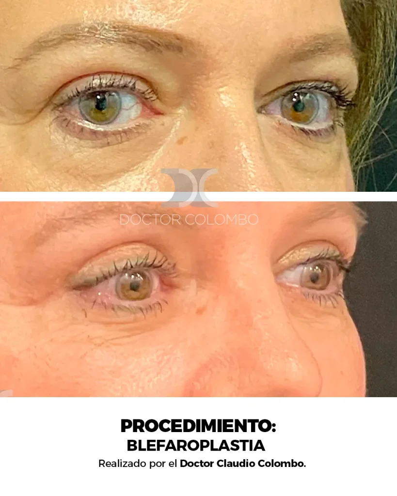 BLEFAROPLASTIA EN PARPADO SUPERIOR E INFERIOR + NANOFAT PERIORBITARIO – CON ANESTESIA LOCAL – AMBULATORIO — 5006 — Perfil derecho