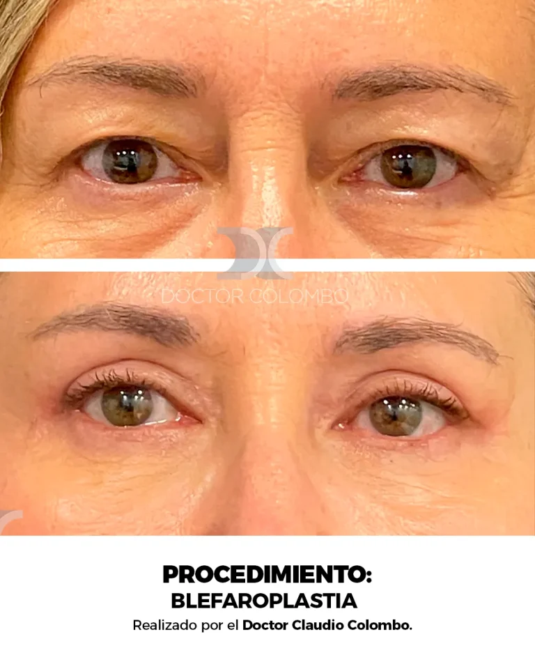 Antes y después de Blefaroplastia