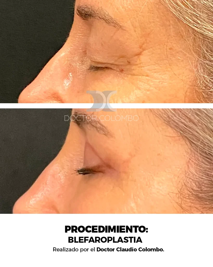 BLEFAROPLASTIA EN PARPADO SUPERIOR + LIPOFILLING – FULL FACE FAT TRANSFER  – CON ANESTESIA LOCAL – AMBULATORIO — 5091 — Perfil izquierdo