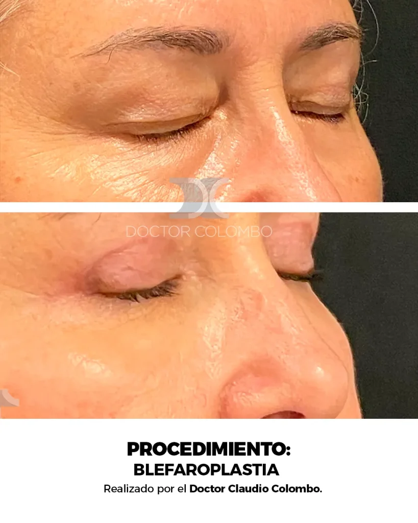 BLEFAROPLASTIA EN PARPADO SUPERIOR + LIPOFILLING – FULL FACE FAT TRANSFER  – CON ANESTESIA LOCAL – AMBULATORIO — 5091 — Perfil derecho