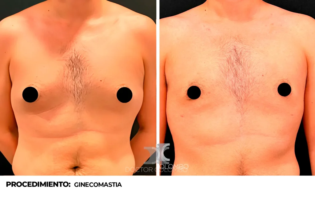 LIPOSUCCIÓN VASER® EN PECTORAL + CARA LATERAL DE TORAX + CURA OPERATORIA DE GINECOMASTIA — Perfil derecho
