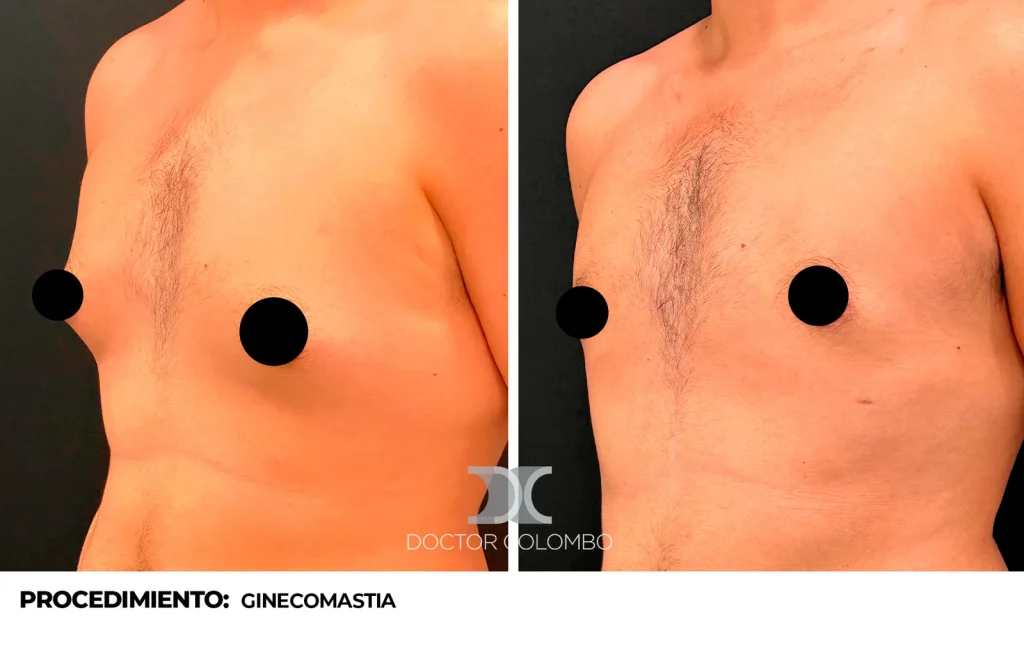 LIPOSUCCIÓN VASER® EN PECTORAL + CARA LATERAL DE TORAX + CURA OPERATORIA DE GINECOMASTIA — Perfil izquierdo