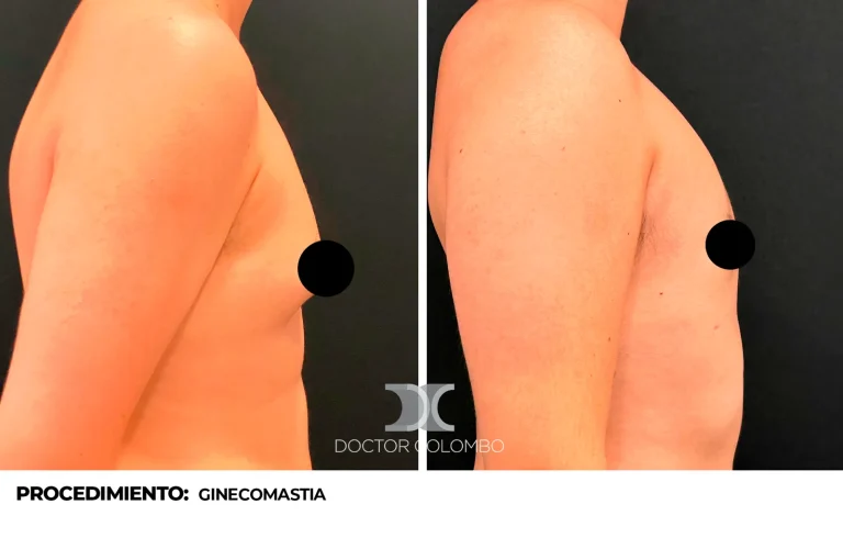 Antes y después de Ginecomastia