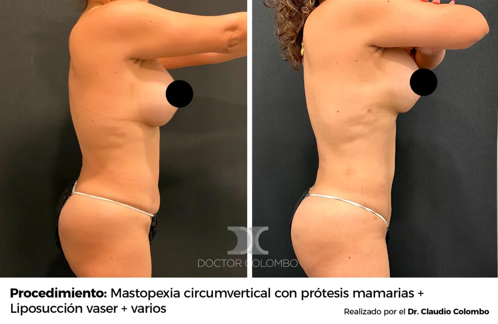 LIPOSUCCIÓN VASER® DE ESPALDA Y SUPRA – CADERAS + LIPOTRANSFERENCIA A GLUTEOS Y CADERAS + MARCACIÓN ABDOMINAL MODERADA — 3388 — Perfil derecho