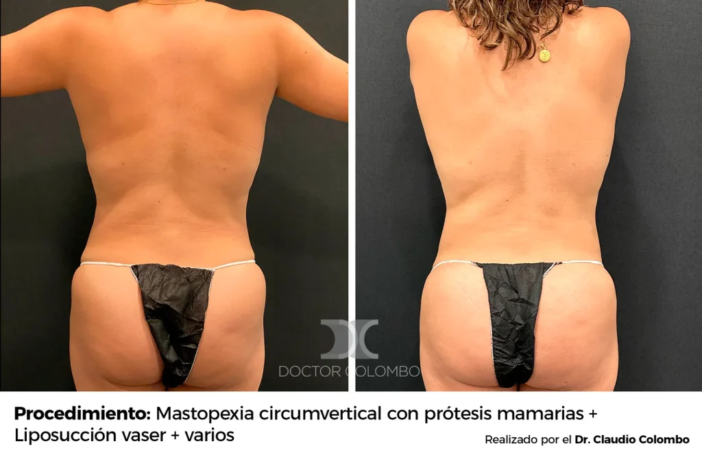 LIPOSUCCIÓN VASER® DE ESPALDA Y SUPRA – CADERAS + LIPOTRANSFERENCIA A GLUTEOS Y CADERAS + MARCACIÓN ABDOMINAL MODERADA — 3388 — Perfil izquierdo