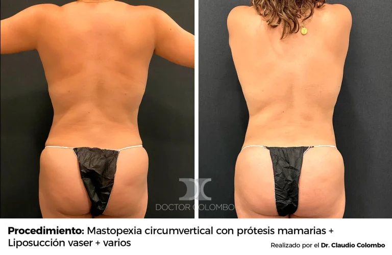 Antes y después de Gluteoplastia