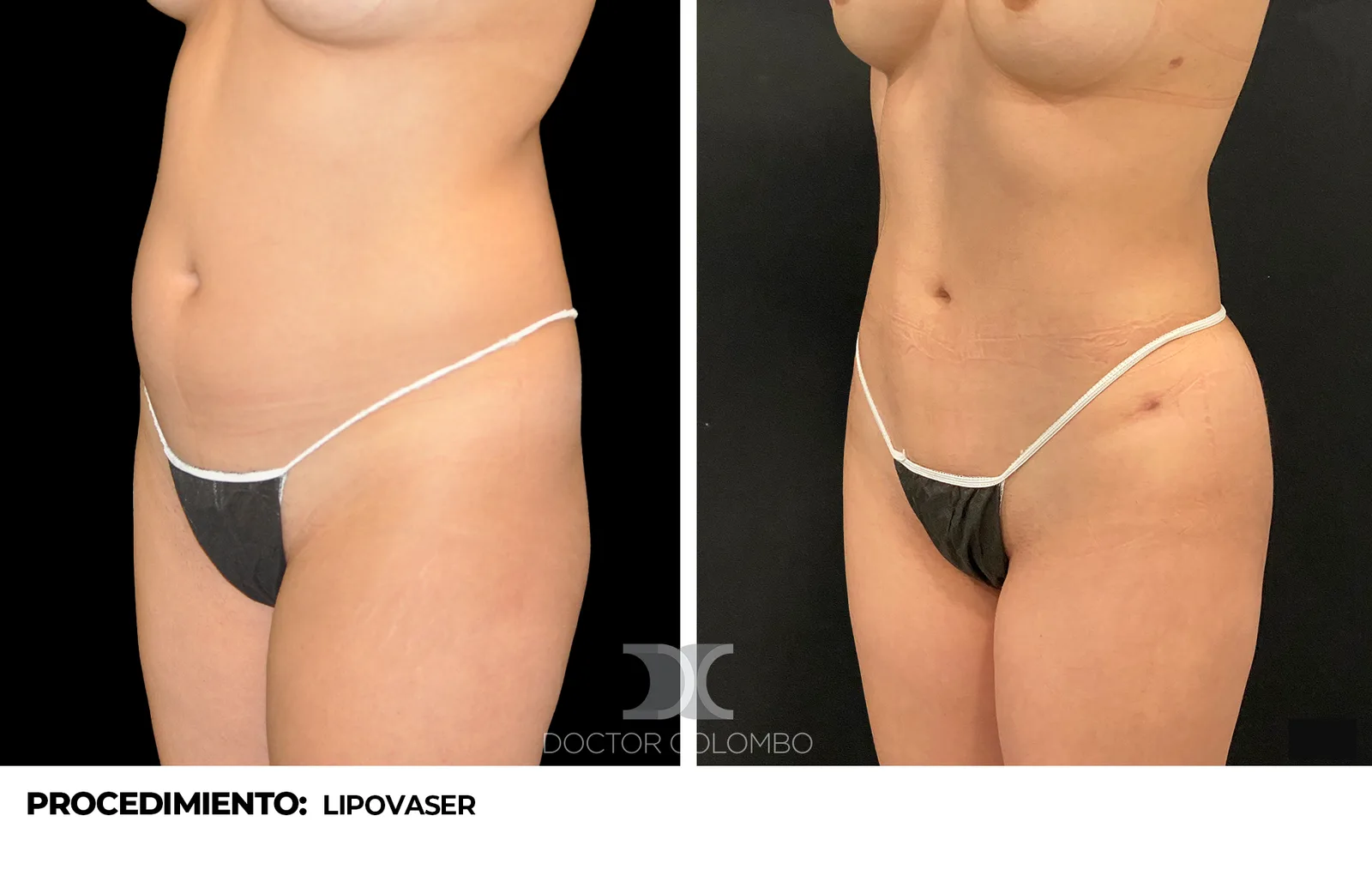 Antes y despu&eacute;s liposucci&oacute;n - Dr. Colombo Madrid