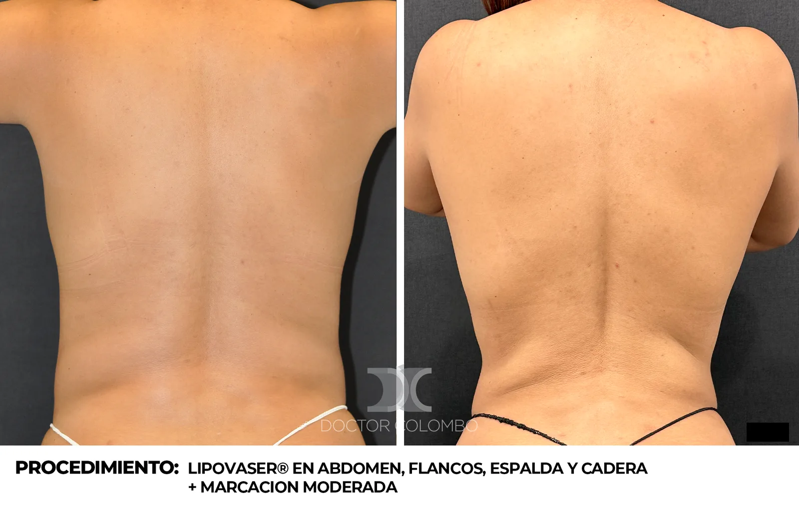 Antes y después liposucción VASER - Dr. Colombo Madrid