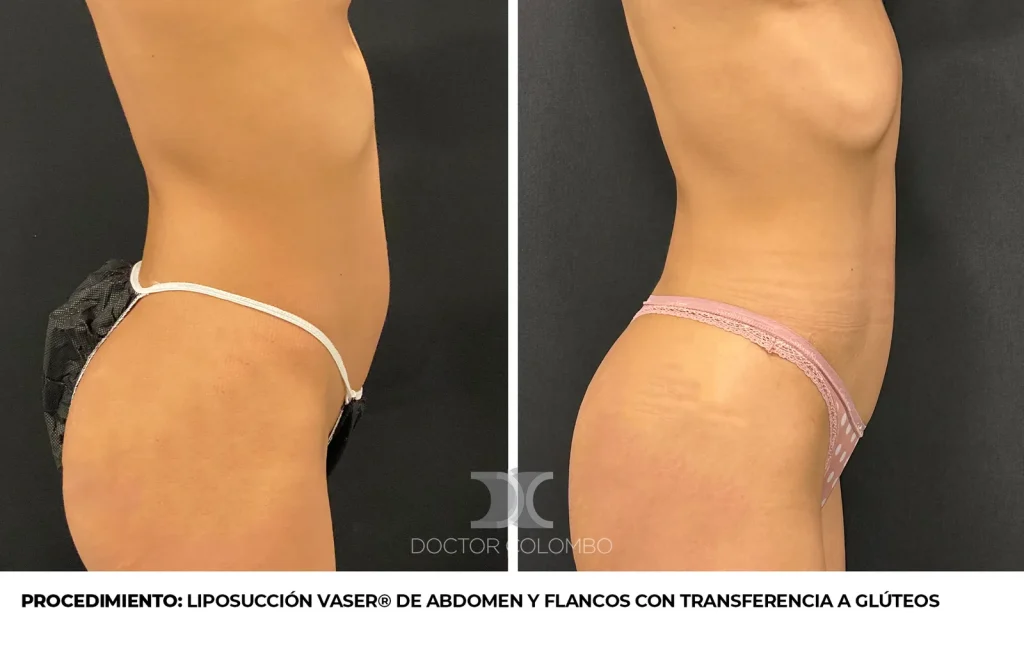 LIPOSUCCIÓN VASER® DE ABDOMEN Y FLANCOS CON TRANSFERENCIA A GLÚTEOS — 3891 — Perfil derecho