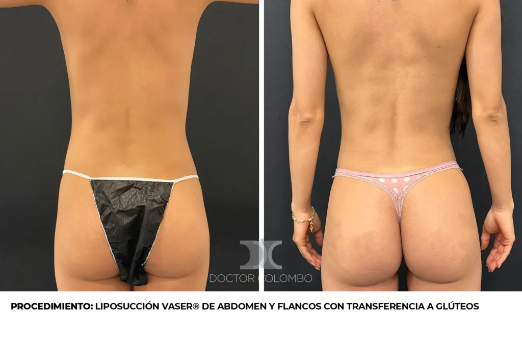 LIPOSUCCIÓN VASER® DE ABDOMEN Y FLANCOS CON TRANSFERENCIA A GLÚTEOS — 3891 — Perfil izquierdo