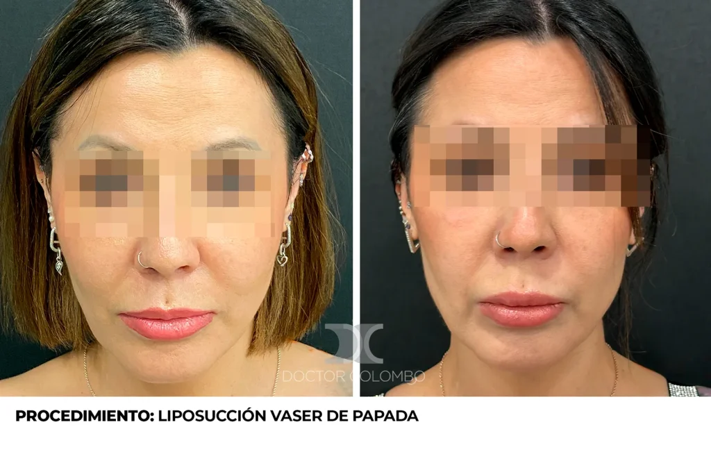 LIPO PAPADA — 4621 — Frontal