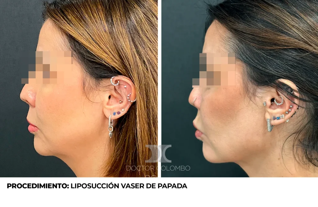 LIPO PAPADA — 4621 — Perfil izquierdo