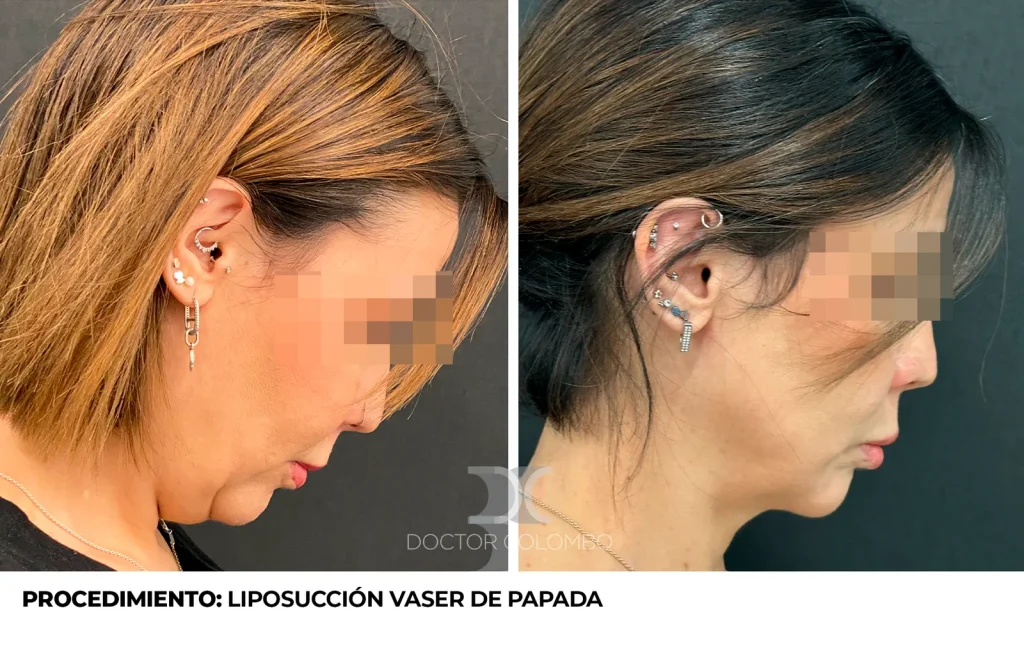 LIPO PAPADA — 4621 — Perfil derecho