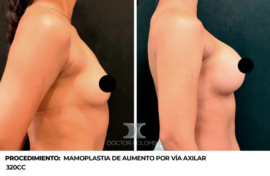 MPA AXILAR — 2650 — Perfil derecho