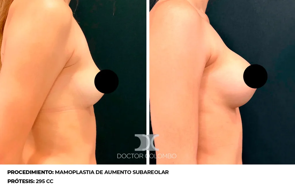 MAMOPLASTIA DE AUMENTO — 3115 — Perfil derecho