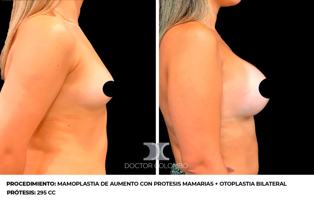 MAMOPLASTIA DE AUMENTO CON PROTESIS MAMARIAS + OTOPLASTIA BILATERAL  – SIN NOCHE DE HOSPITALIZACIÓN — 3290 — Perfil derecho
