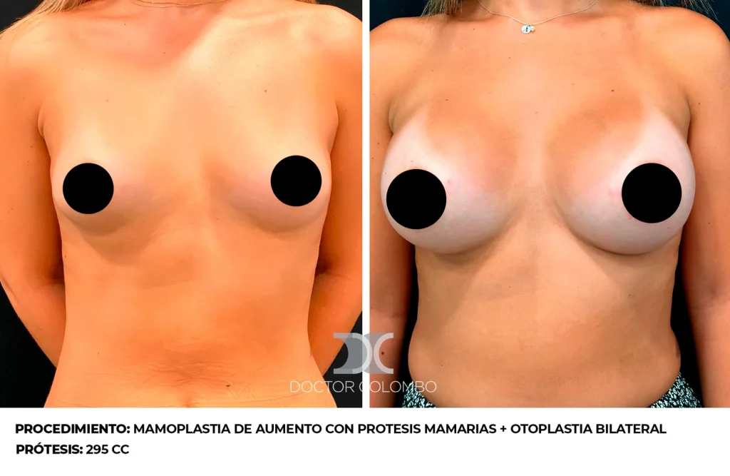 MAMOPLASTIA DE AUMENTO CON PROTESIS MAMARIAS + OTOPLASTIA BILATERAL - SIN NOCHE DE HOSPITALIZACIÓN — 3290-B
