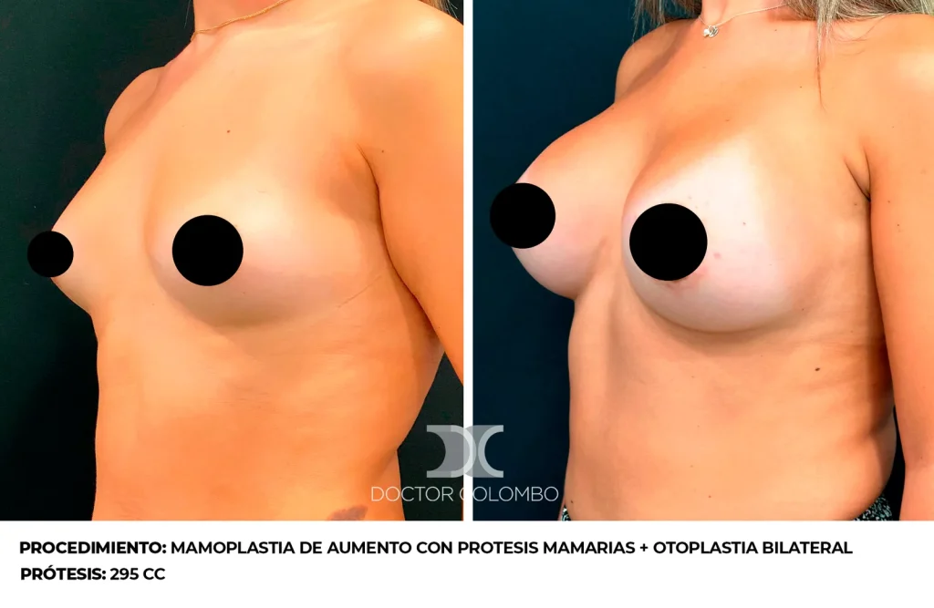 MAMOPLASTIA DE AUMENTO CON PROTESIS MAMARIAS + OTOPLASTIA BILATERAL  – SIN NOCHE DE HOSPITALIZACIÓN — 3290-B — Perfil izquierdo