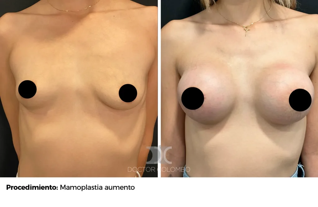 MASTO CON PROTESIS — 1085 — Perfil derecho