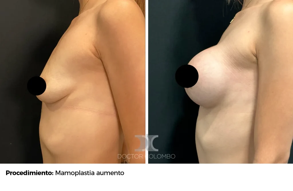 MASTO CON PROTESIS — 1085 — Perfil izquierdo