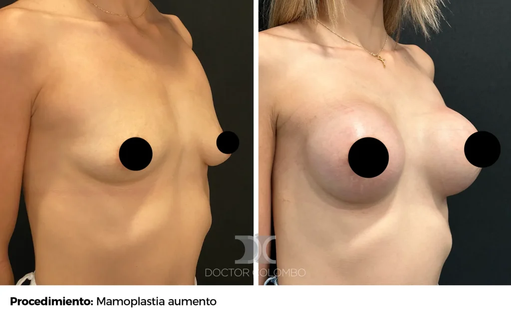 MASTO CON PROTESIS — 1085 — Frontal