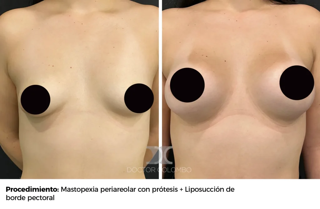 MASTOPEXIA PERIAREOLAR CON PROTESIS – SIN NOCHE DE HOSPITALIZACIÓN — 2520 — Perfil derecho