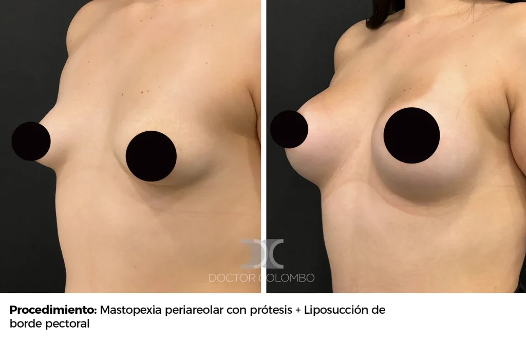 MASTOPEXIA PERIAREOLAR CON PROTESIS – SIN NOCHE DE HOSPITALIZACIÓN — 2520 — Perfil izquierdo