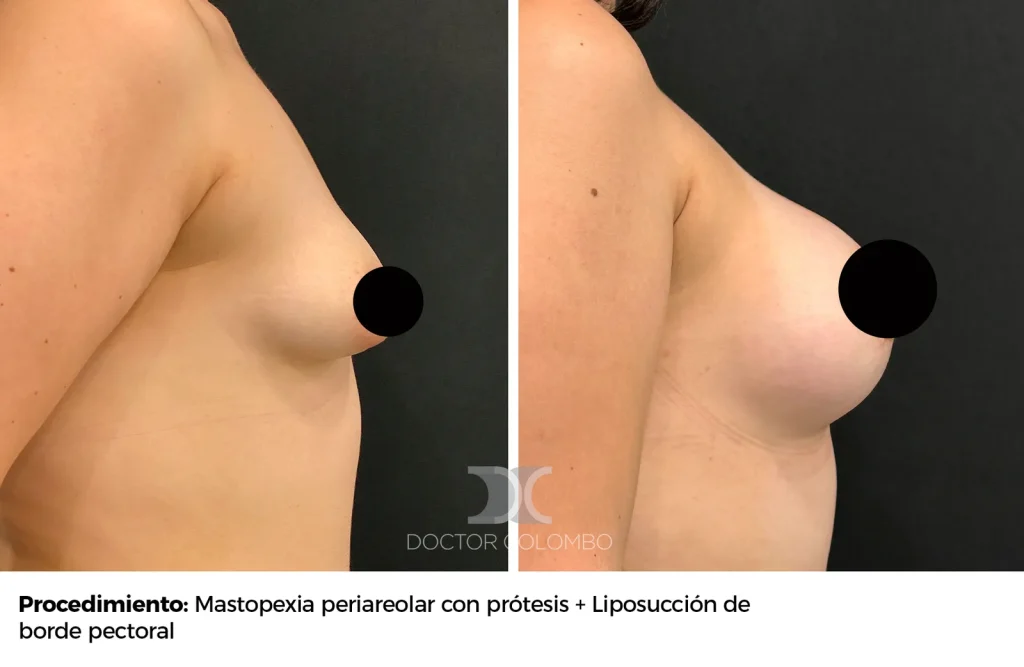 MASTOPEXIA PERIAREOLAR CON PROTESIS – SIN NOCHE DE HOSPITALIZACIÓN — 2520 — Frontal