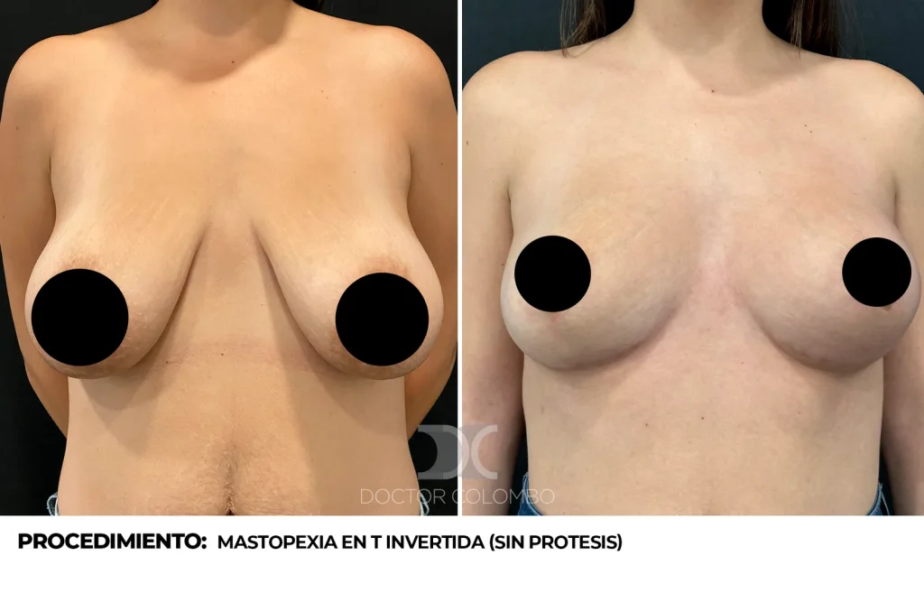 MASTOPEXIA EN T INVERTIDA (SIN PROTESIS) — 2919 — Perfil derecho