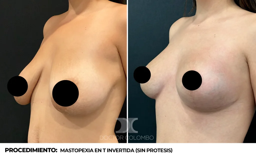 MASTOPEXIA EN T INVERTIDA (SIN PROTESIS) — 2919 — Perfil izquierdo