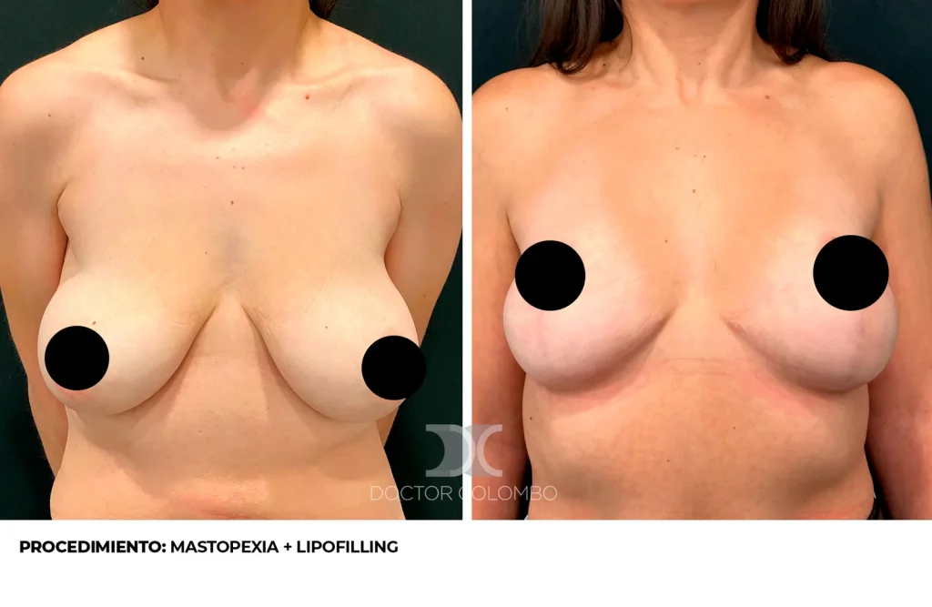 MASTOPEXIA T INVERTIDA CON AUTOPROTESIS + LIPOTRANSFERENCIA DE ABDOMEN A POLO SUPEROINTERNO – SIN NOCHE DE HOSPITALIZACIÓN — 3426 — Perfil derecho