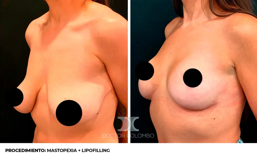 MASTOPEXIA T INVERTIDA CON AUTOPROTESIS + LIPOTRANSFERENCIA DE ABDOMEN A POLO SUPEROINTERNO – SIN NOCHE DE HOSPITALIZACIÓN — 3426 — Perfil izquierdo
