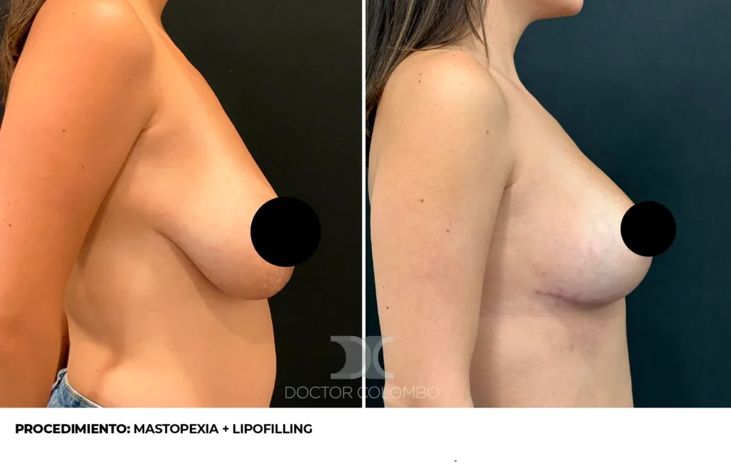 MASTOPEXIA T INVERTIDA CON AUTOPROTESIS + LIPOTRANSFERENCIA DE ABDOMEN A POLO SUPEROINTERNO – SIN NOCHE DE HOSPITALIZACIÓN — 3426 — Frontal