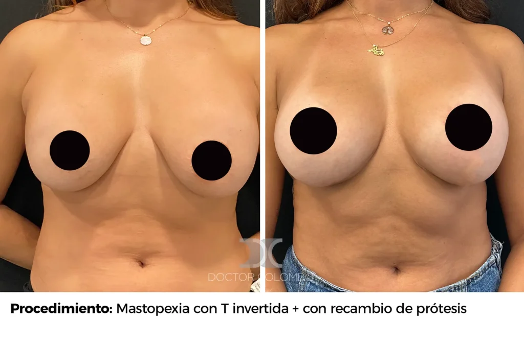 MASTOPEXIA EN T INVERTIDA CON RECAMBIO DE PROTESIS — 3630 — Perfil derecho
