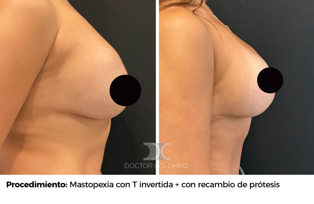 MASTOPEXIA EN T INVERTIDA CON RECAMBIO DE PROTESIS — 3630 — Frontal
