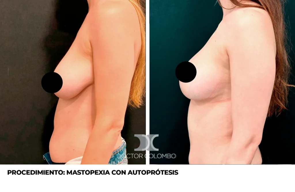 MASTOPEXIA EN T INVERTIDA CON AUTOPROTESIS + LIPOSUCCIÓN DE COLA DE MAMA — 4373 — Perfil izquierdo