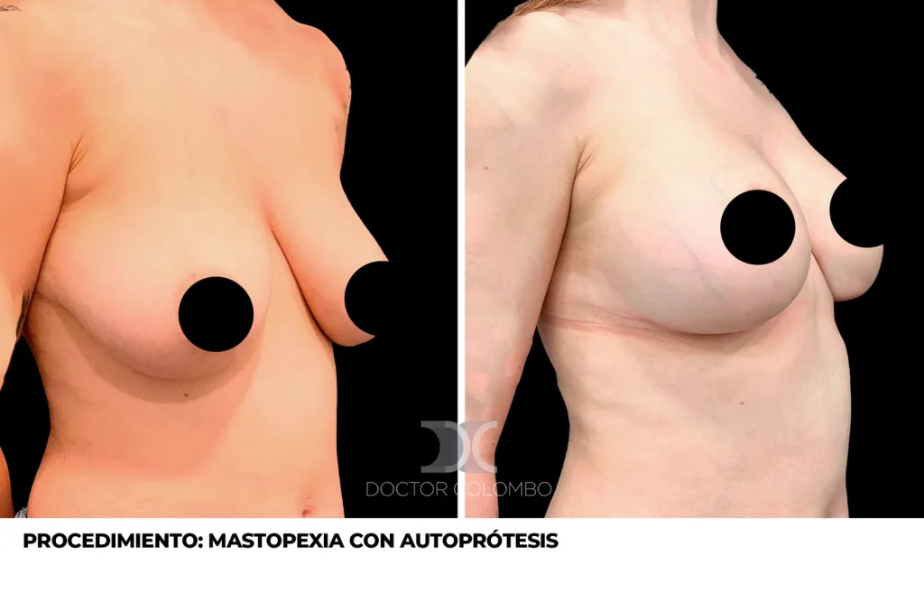 MASTOPEXIA EN T INVERTIDA CON AUTOPROTESIS + LIPOSUCCIÓN DE COLA DE MAMA — 4373 — Frontal